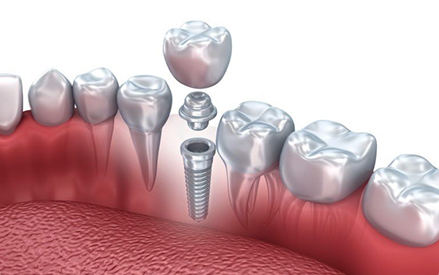 Prospek pengembangan bahan titanium medis detail.